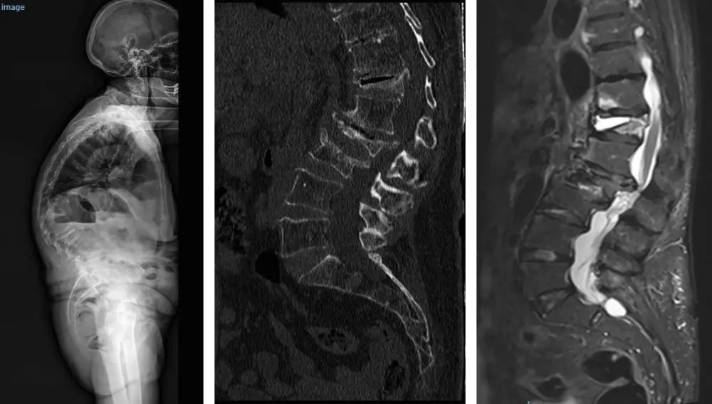 Prevención de fracturas por osteoporosis