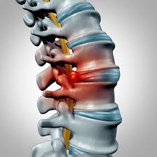 Ilustración de una hernia de disco intervertebral